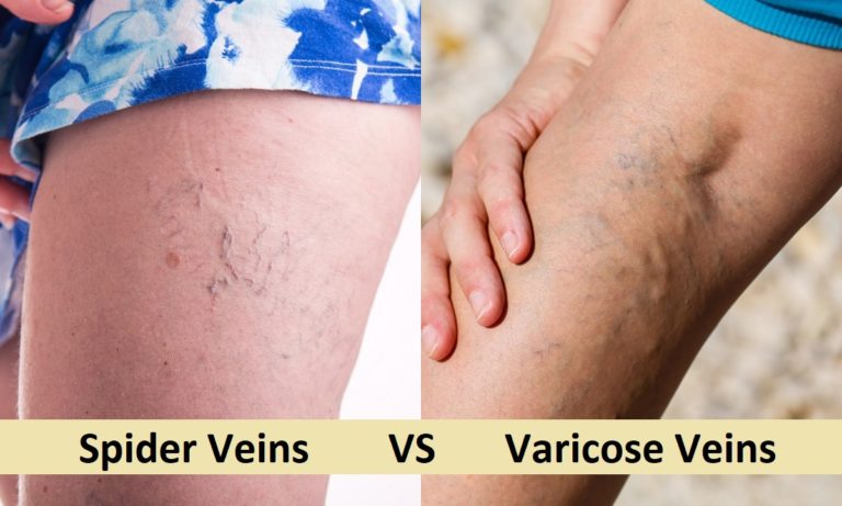 Varicose veins dermatology