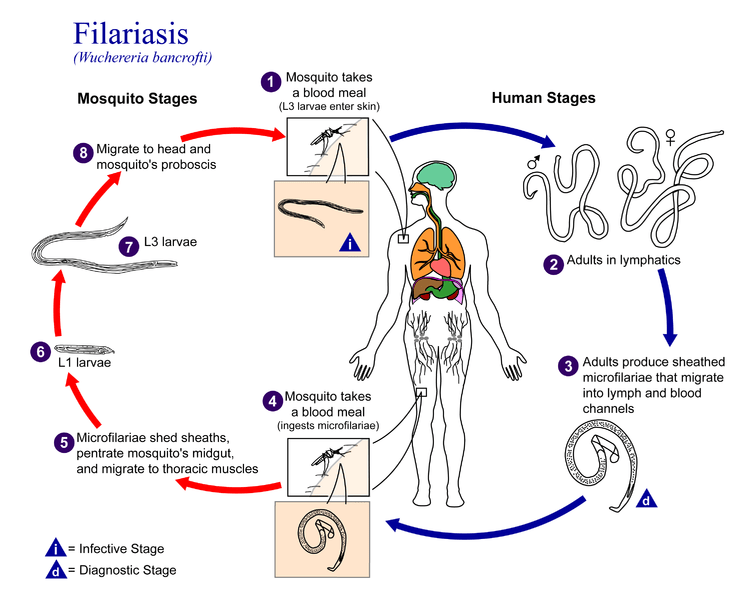 Apa perbedaan elephantiasis dengan ascariasis